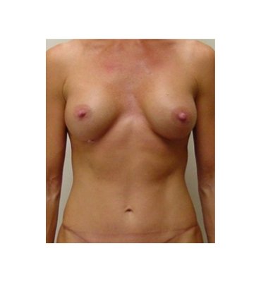 Breast Implant With Lower Abdominoplasty After